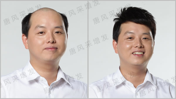 南寧織發(fā)補(bǔ)發(fā)效果怎么樣？