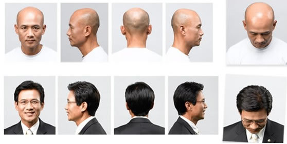 廣州這邊禿頂怎么辦？可以修復(fù)么？