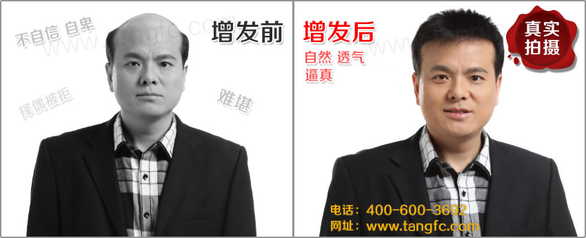 男士禿頂是普見的現(xiàn)象么？