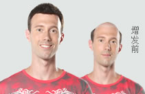 沈陽店男士織發(fā)補發(fā)案例