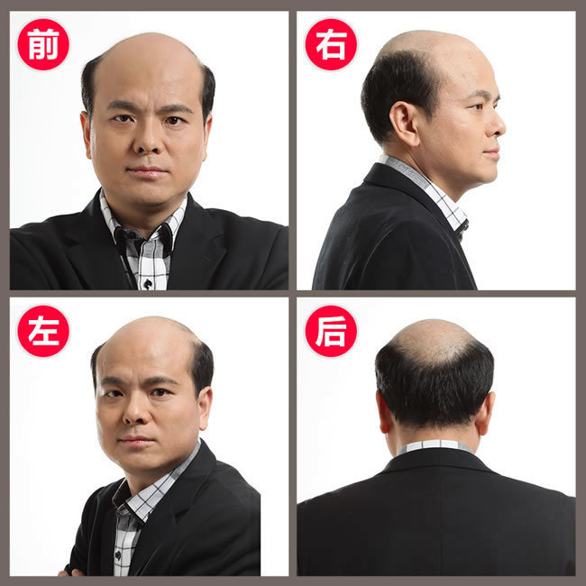 前額兩邊頭發(fā)稀疏怎么辦？看了你就知道怎么解決！