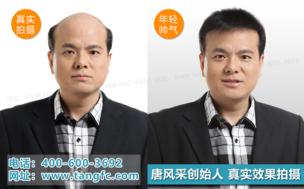 禿頂補發(fā)就選唐風(fēng)采補發(fā)機構(gòu)