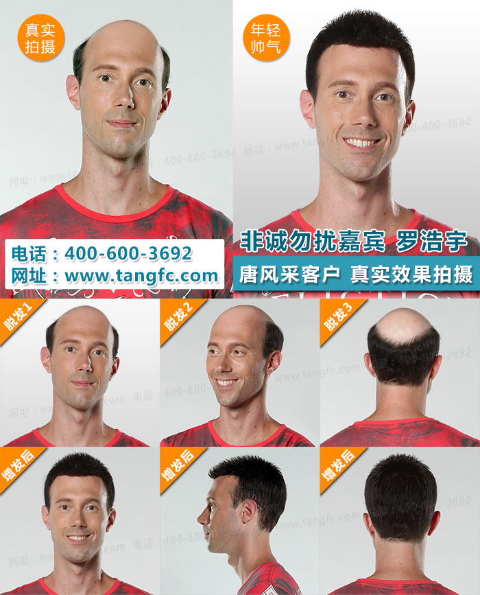 脫發(fā)真的沒救了嗎？教你如何逆襲