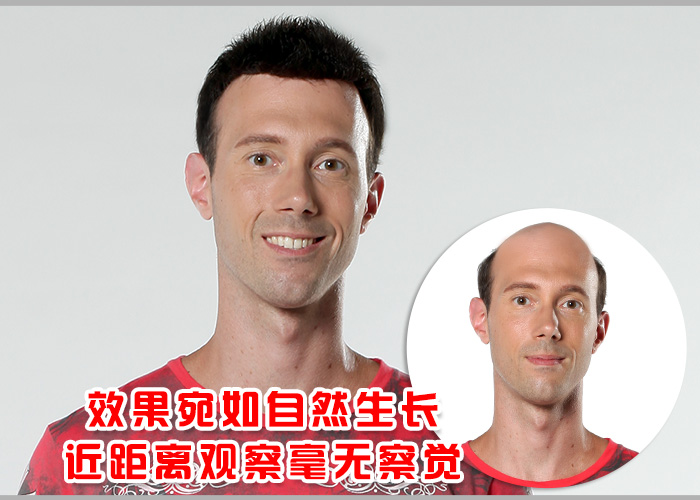 禿發(fā)可以補(bǔ)發(fā)嗎？補(bǔ)發(fā)會掉嗎？