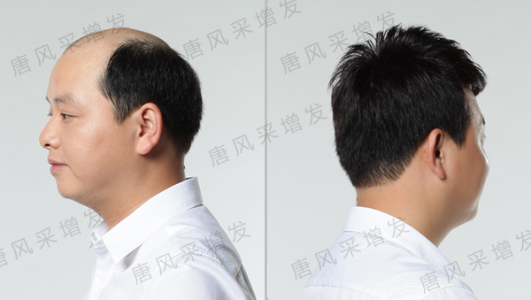 脫發(fā)后怎么辦？脫發(fā)補(bǔ)發(fā)也許是你最好的選擇！