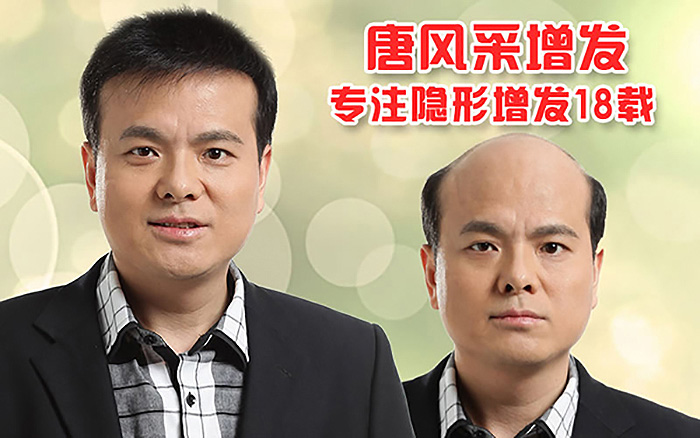 脂溢性脫發(fā)能治好嗎？專業(yè)機(jī)構(gòu)為你解答發(fā)體癥狀