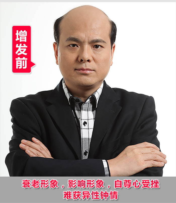 掉頭發(fā)很厲害怎么辦？2016新解決掉發(fā)的方法