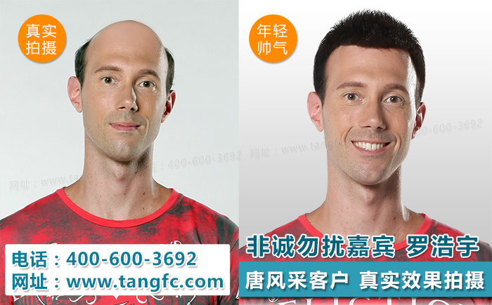 揭密掉發(fā)嚴(yán)重怎么辦？看這里