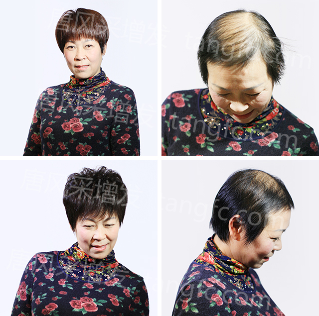 蘭州織發(fā)補(bǔ)發(fā)哪家好？露出發(fā)際線(xiàn)，效果超贊