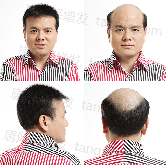 紹興織發(fā)補(bǔ)發(fā)需要多少錢？收費(fèi)公開透明的就是它