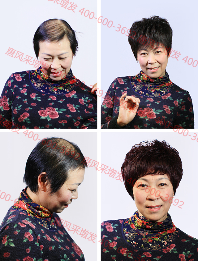 合肥織發(fā)定制解決脫發(fā)，什么品牌值得信賴？