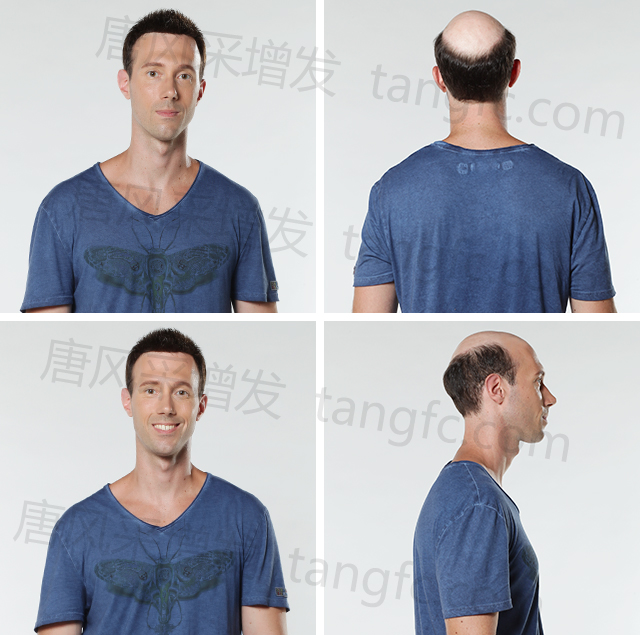 發(fā)際線高的同學(xué)，在同齡人中立馬看出年齡差距&nbsp;