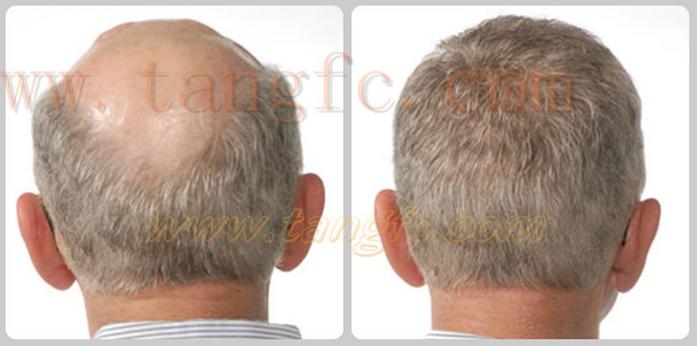 白發(fā)在金華補(bǔ)發(fā)機(jī)構(gòu)這里，這都不是事！