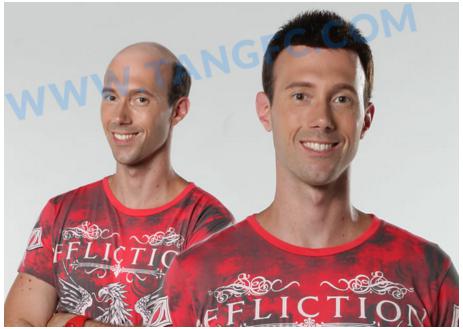 遭遇地中海脫發(fā)，顏值再高也沒用！