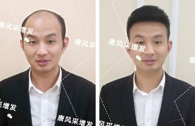 輸了頭發(fā)不能輸氣質(zhì)，看帥哥的逆襲之路！