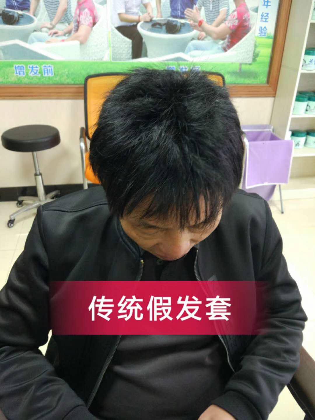 脫發(fā)謝頂壓力大，增發(fā)補發(fā)一身輕！