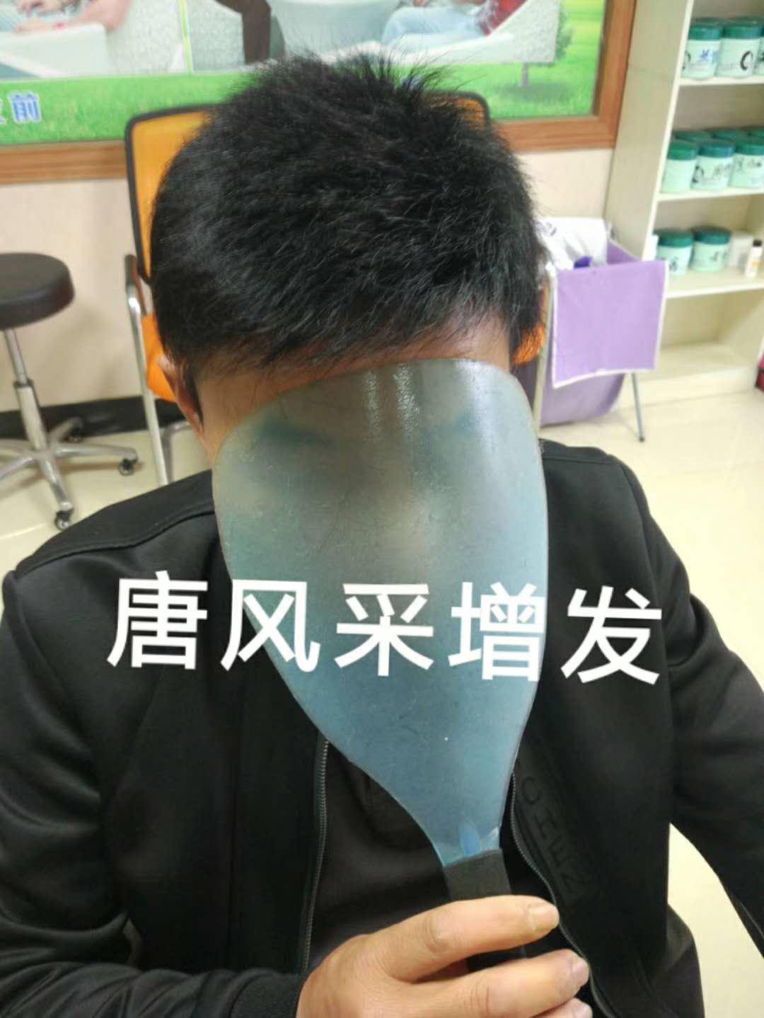 脫發(fā)謝頂壓力大，增發(fā)補發(fā)一身輕！