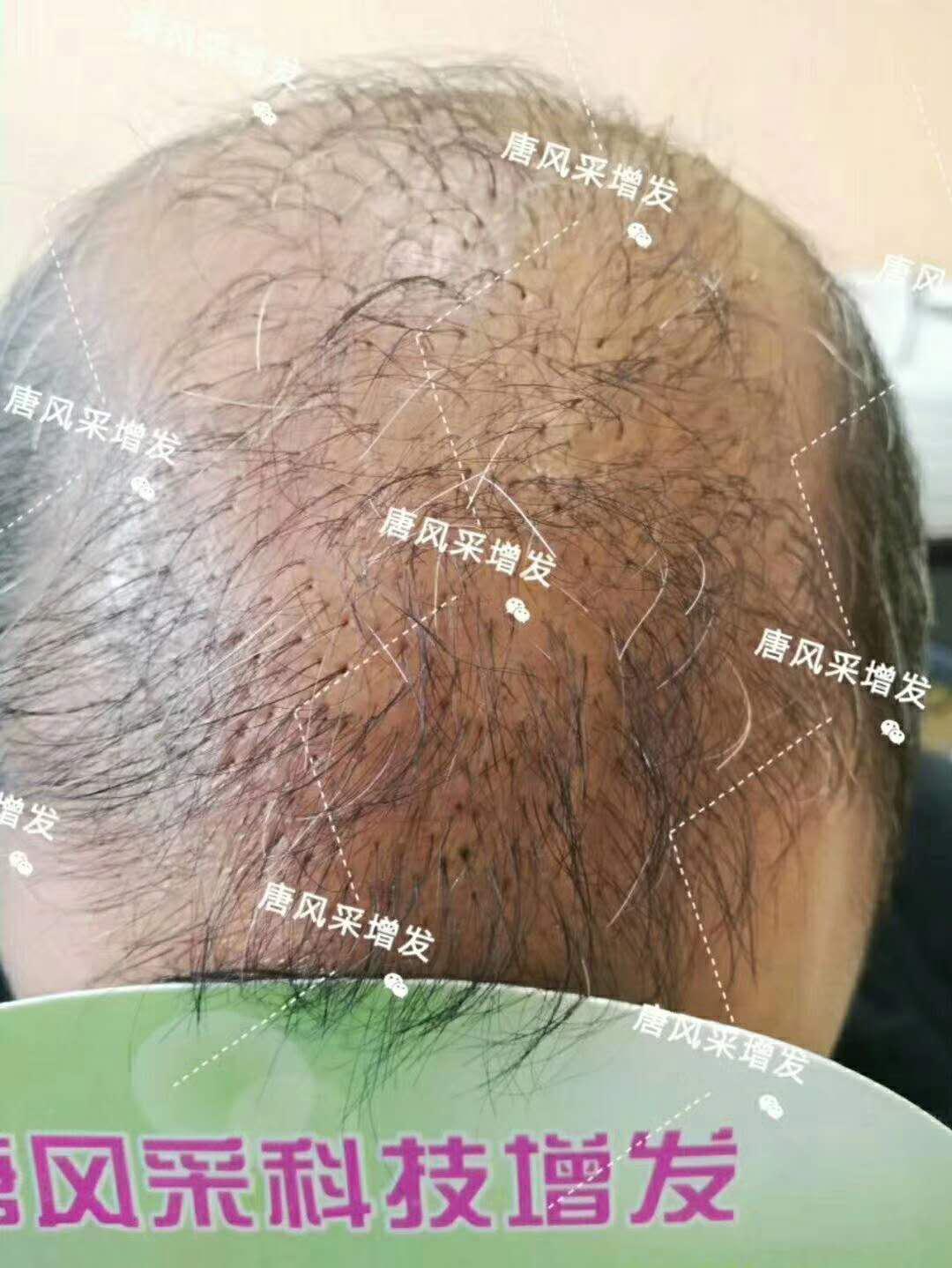 頭發(fā)稀少怎么變密？