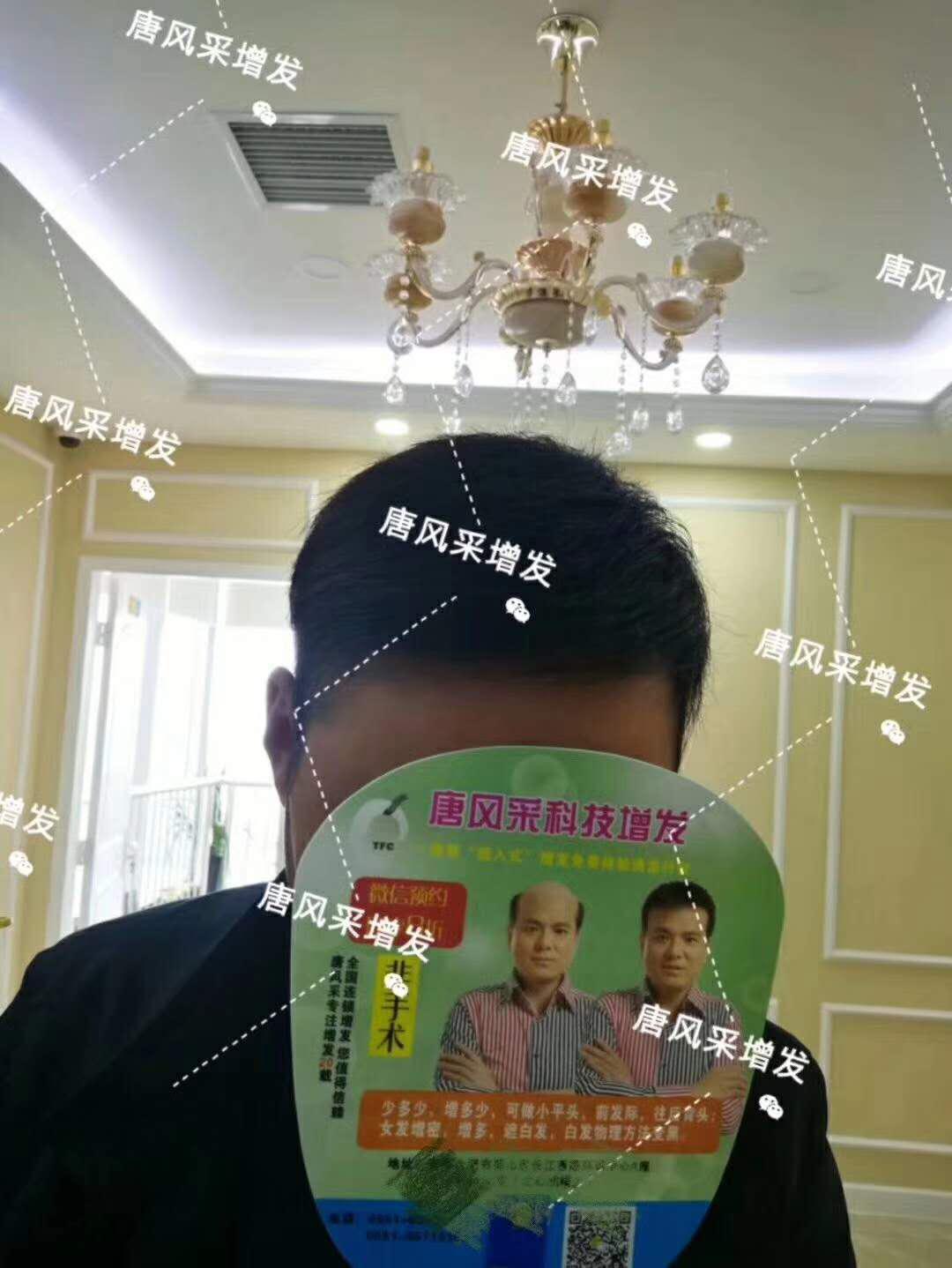 頭發(fā)稀少怎么變密？