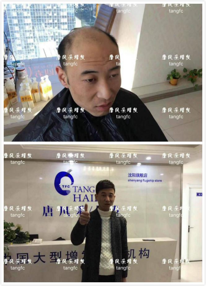 為脫發(fā)者解千愁，增發(fā)前后的驚人對比！