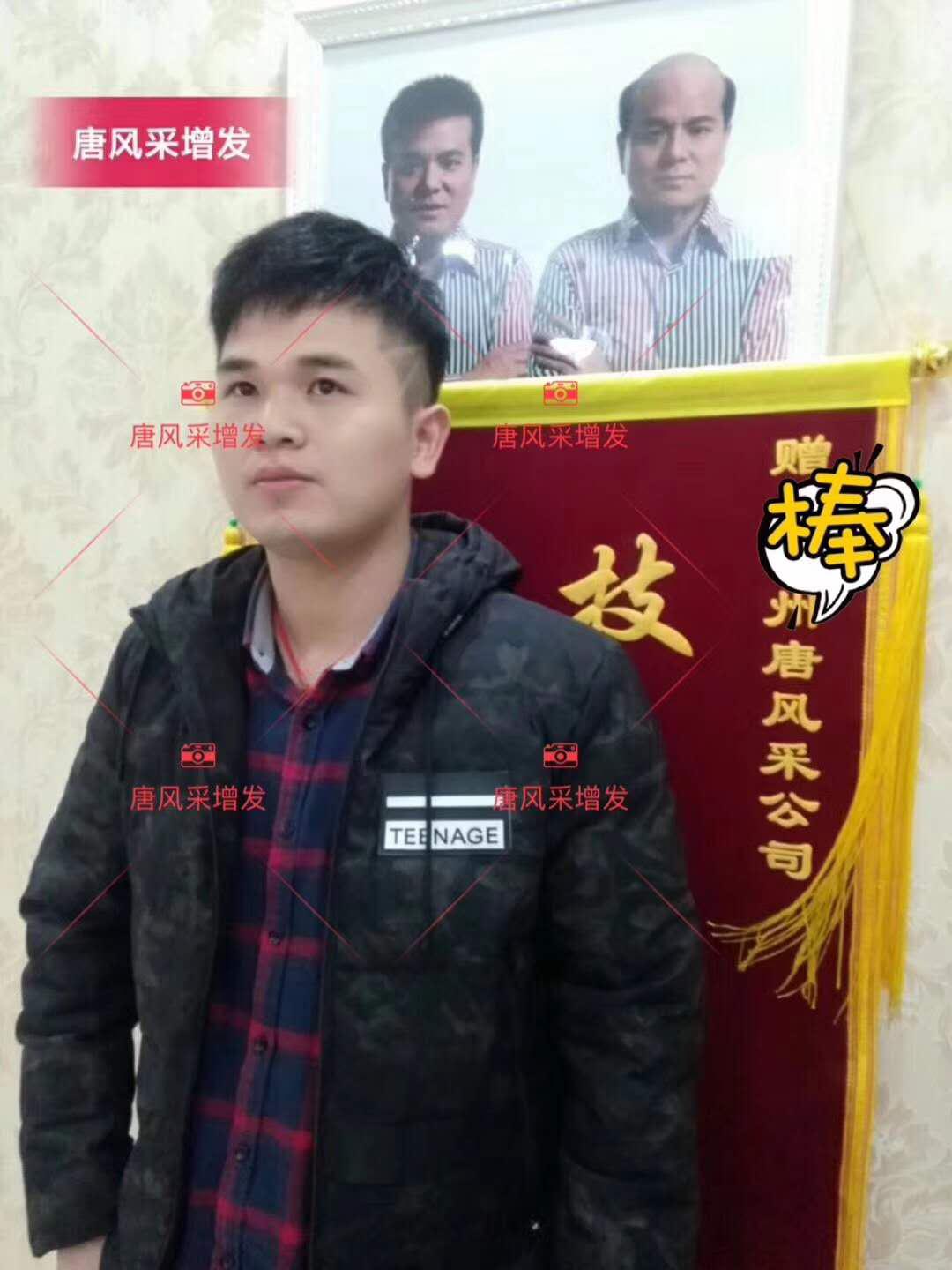 為脫發(fā)者解千愁，增發(fā)前后的驚人對比！