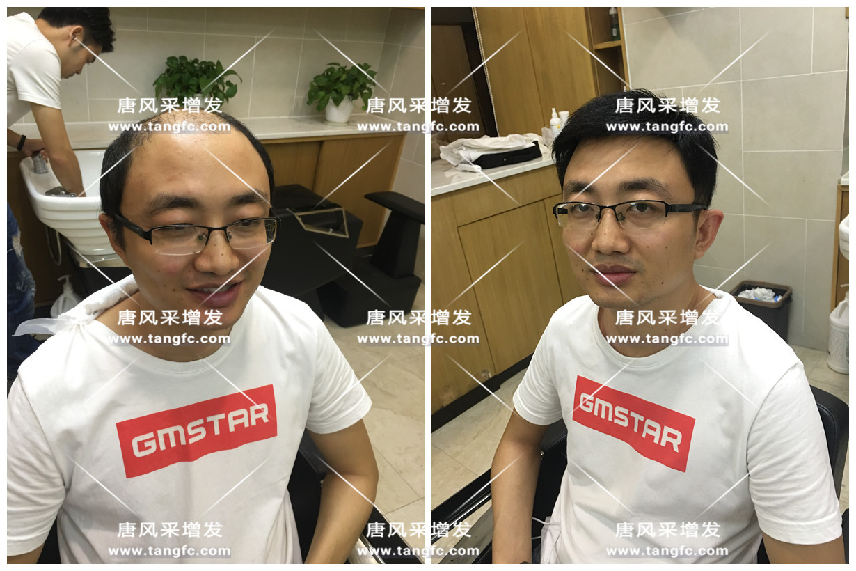 謝頂會坑一輩子？ 我不禁摸了摸自己頭發(fā)