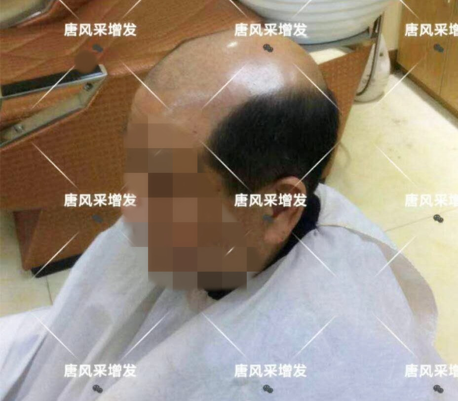 男人脫發(fā)原因多，不能一味怨腎虧！