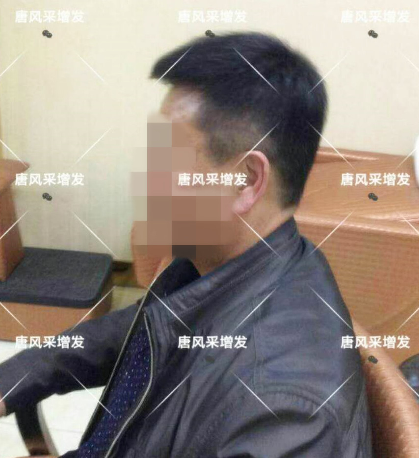 男人脫發(fā)原因多，不能一味怨腎虧！