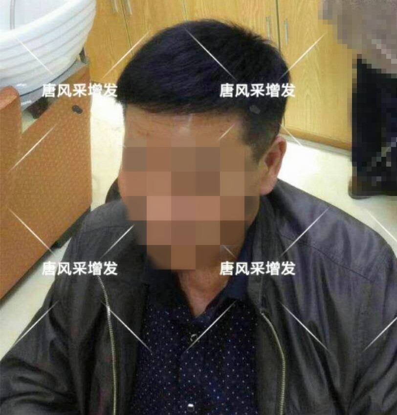 男人脫發(fā)原因多，不能一味怨腎虧！