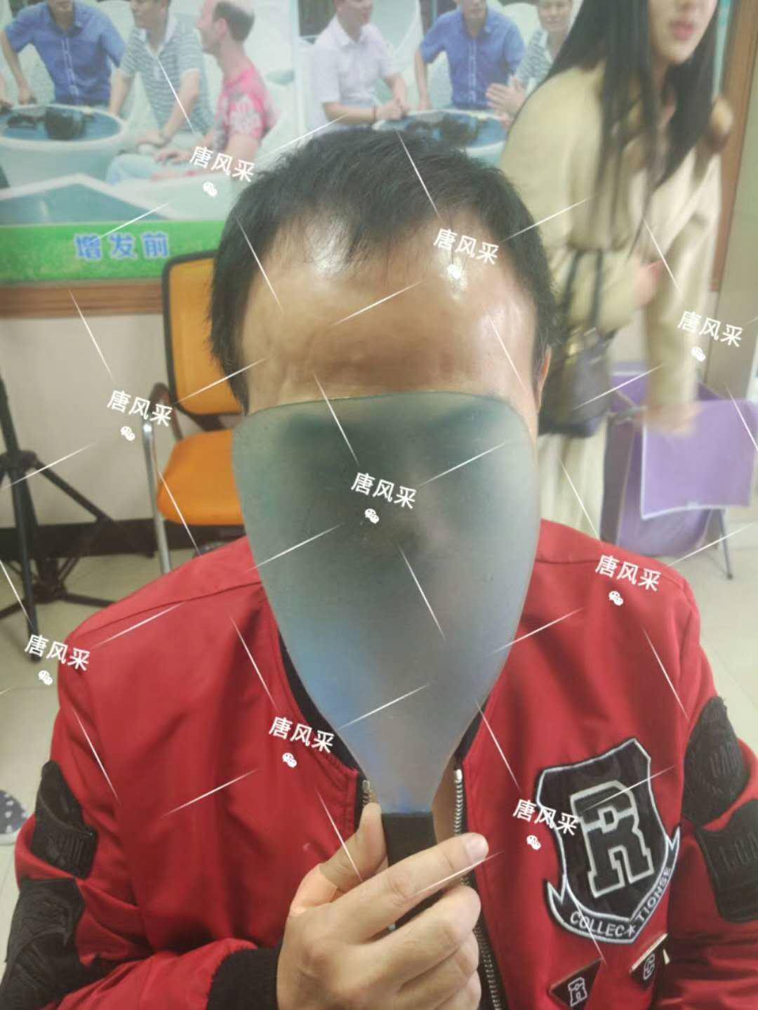 男人脫發(fā)原因多，不能一味怨腎虧！