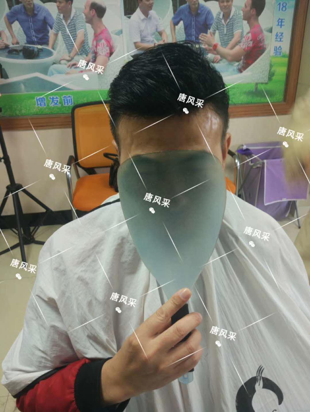 男人脫發(fā)原因多，不能一味怨腎虧！