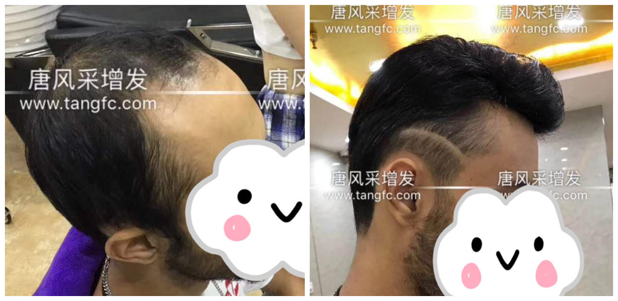 男士假發(fā)容易看出來嗎？看看做過頭發(fā)的發(fā)友怎么說！