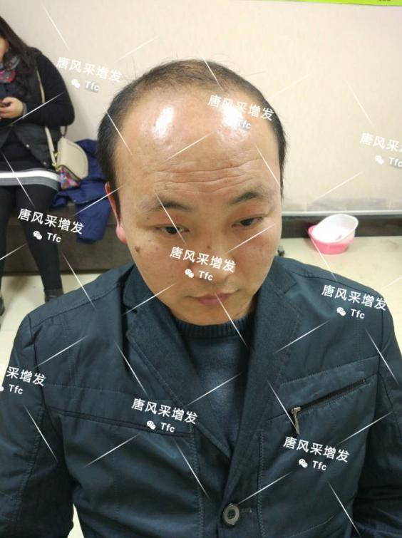 人民公仆也脫發(fā)，廈門夏先生增發(fā)記