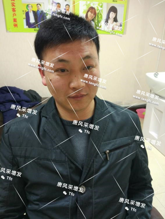 人民公仆也脫發(fā)，廈門夏先生增發(fā)記
