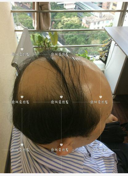 存款重要還是頭發(fā)重要？聽聽李先生怎么說！