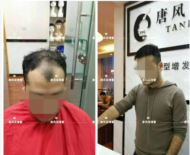 謝頂是顏值也拯救不了的尷尬！