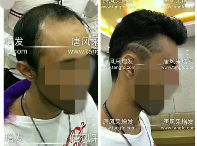 謝頂是顏值也拯救不了的尷尬！