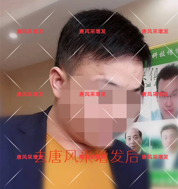 謝頂是顏值也拯救不了的尷尬！