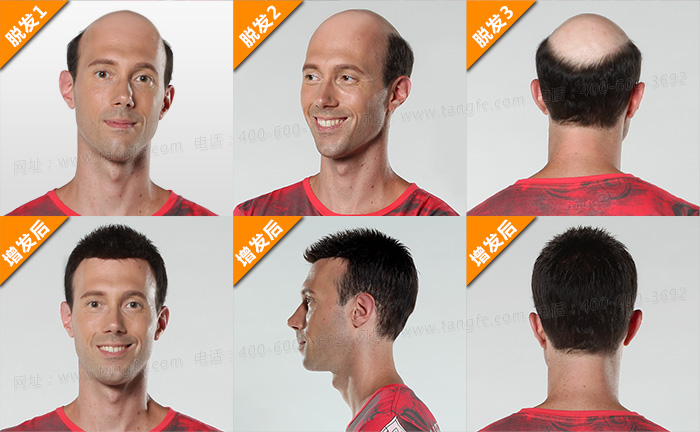 長沙補發(fā)大概能用多久，什么發(fā)型都可以做嗎？