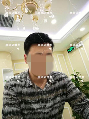 嘉興買隱形假發(fā)哪家好？很多人選擇嗎？