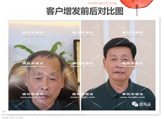 雙節(jié)同慶，給脫發(fā)的父親什么禮物，讓父親“年輕10歲”的神