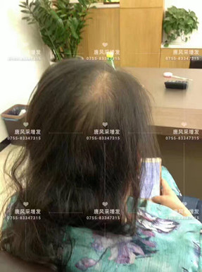 頭發(fā)稀少了，我該拿什么來拯救你？