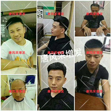 臺(tái)州假發(fā)專賣選什么品牌？禿發(fā)謝頂用假發(fā)好嗎？