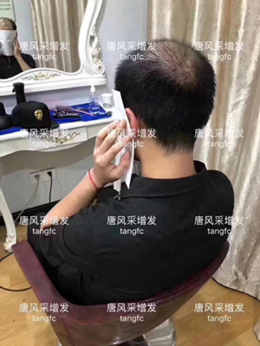 西寧補發(fā)哪里好誰知道？ 90后脫發(fā)了想做補發(fā)！