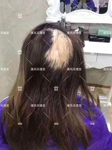 西寧織發(fā)補發(fā)需要多少錢,哪家補發(fā)技術(shù)好？