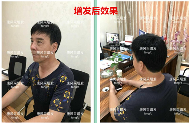 如何生發(fā)密發(fā)?到底有沒有生發(fā)奇效的藥物呢？