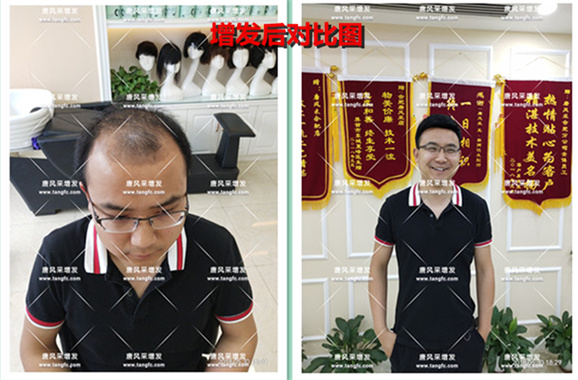 他被脫發(fā)“啃老”是與遺傳有關??！