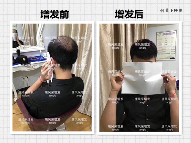 防偷防盜防不了發(fā)際線, 變禿頂了怎么辦？