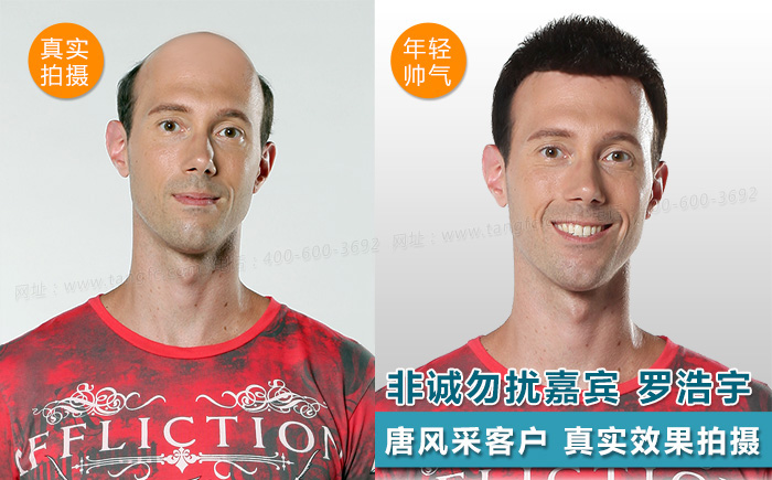 防偷防盜防不了發(fā)際線, 變禿頂了怎么辦？