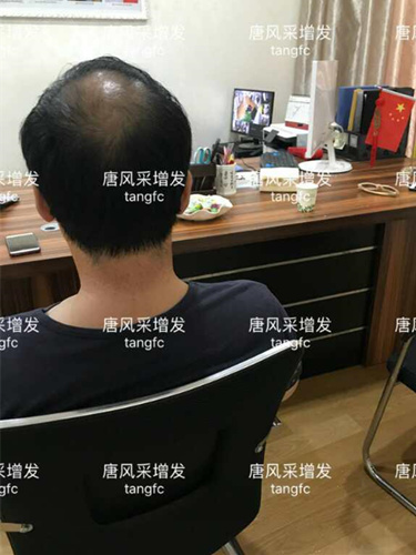 朋友碰面不敢認(rèn)，直擊發(fā)友增發(fā)后的真實(shí)改變！